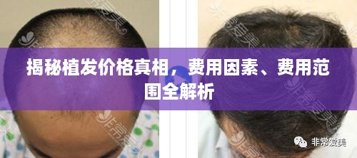 揭秘植發(fā)價格真相，費用因素、費用范圍全解析